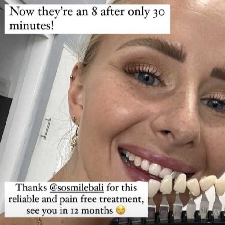 Woman smiling with white teeth after So Smile summer whitening treatment in Bali